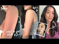 HOW I CLEARED MY KP (KERATOSIS PILARIS) & ACNE | Before & After