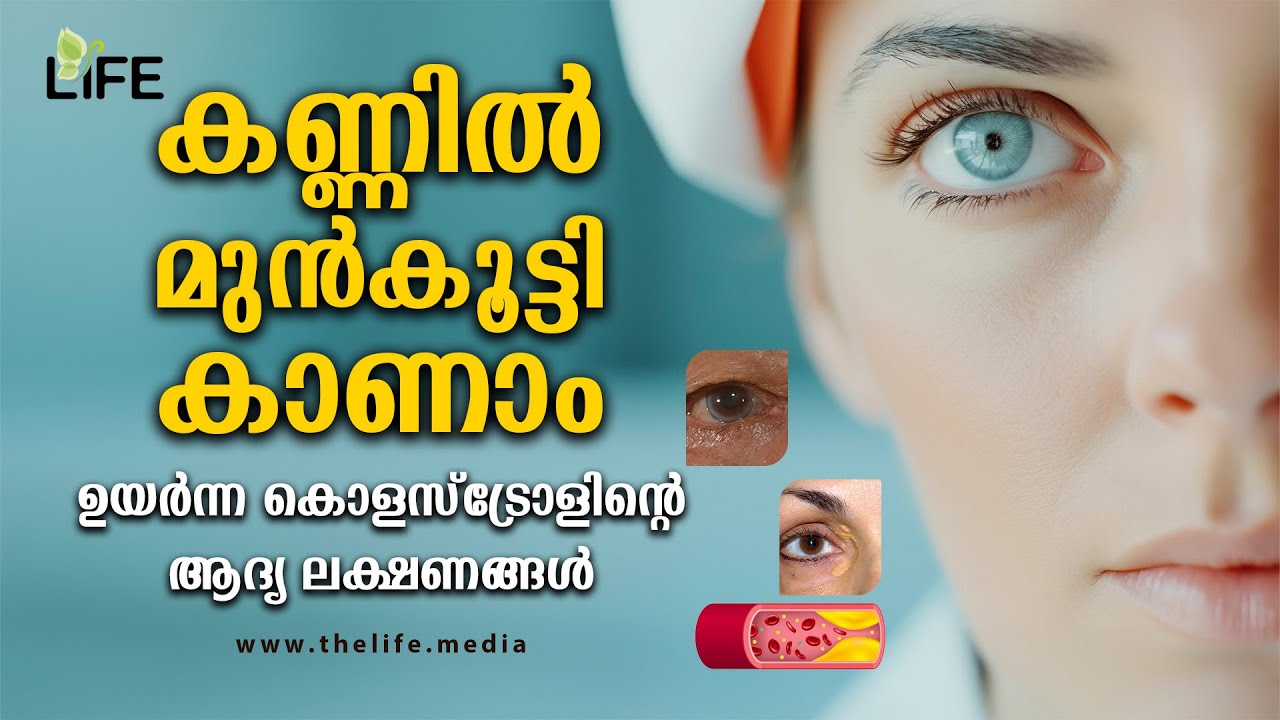 കണ്ണിൽ കാണാം ഉയർന്ന കൊളസ്ട്രോൾ! | Cholesterol Warning Signs in Eyes | The Life Media