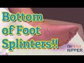How to get splinters out foot?  Dr Nail Nipper and 30 Splinters on Bottom [Callus Tuesday] (2021)
