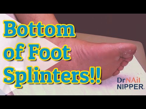 Video: Moet jy splinters verwyder?