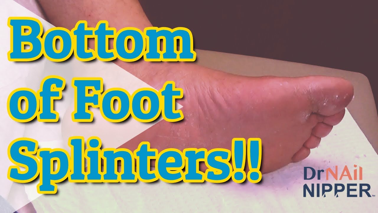 How to get splinters out foot? Dr Nail Nipper and 30 Splinters on