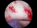 S01E24 - EarWax Cleaning in Shocking Canal, Solid As A Stone Black Ear Wax Removed