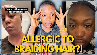 Women Are Becoming ALLERGIC To Braiding Hair?!