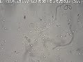 Entamoeba Histolytica Trophozoite In Stool