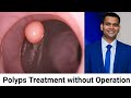 Polyps - Treatment Without Operation and Causes