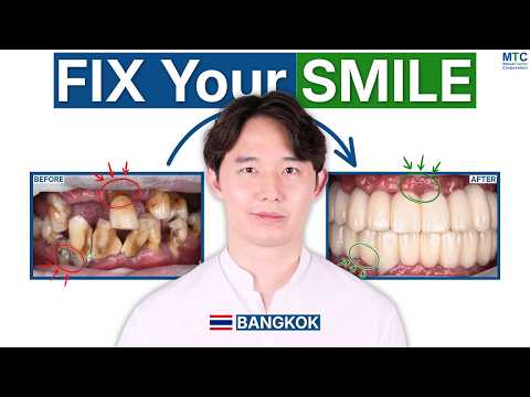 Full Mouth Dental Implants in Bangkok, Thailand: How Proper Planning Prevents Failure