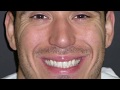 Bioclear Veneers: 5 teeth in 5 mins