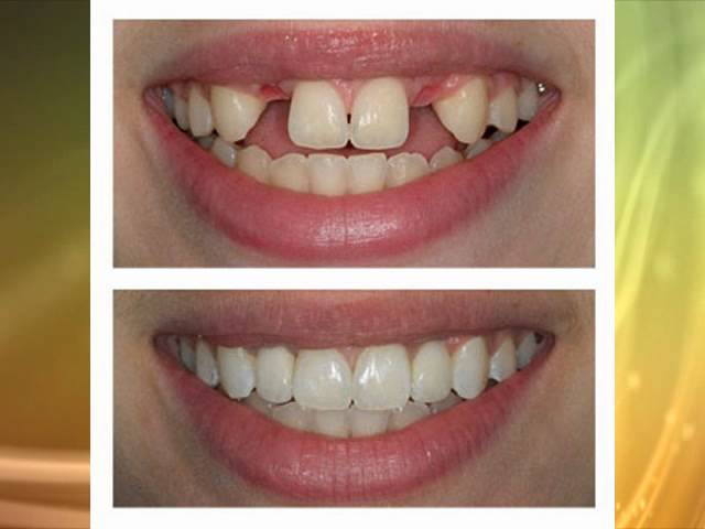 tooth implant before after