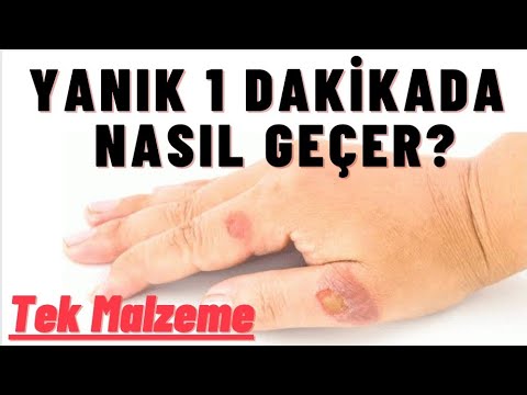 Video: Sıcak Tutkal Yanığı Nasıl Tedavi Edilir?