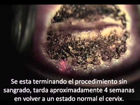 Dr. Ruben Molina | Laser CO2 en Displasias del Cervix en Matamoros