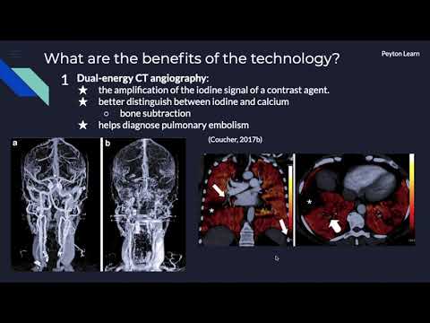 Video: Imbasan CT Dual-energy 3 Fasa Sebagai Modaliti Pengimejan Pencegahan Yang Sesuai Untuk Pengenalpastian Adenoma Parathyroid Yang Tidak Setempat: Kajian Prospektif