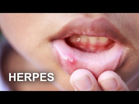 Video: Herpes Pri Otrocih Tipa 6 Na Ustnicah, Grlu In Telesu, Zdravljenje