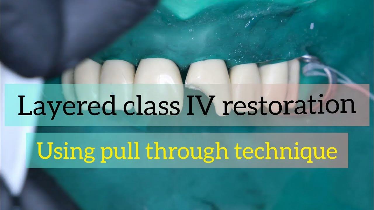 Polychromatic Class IV composite restoration step by step with