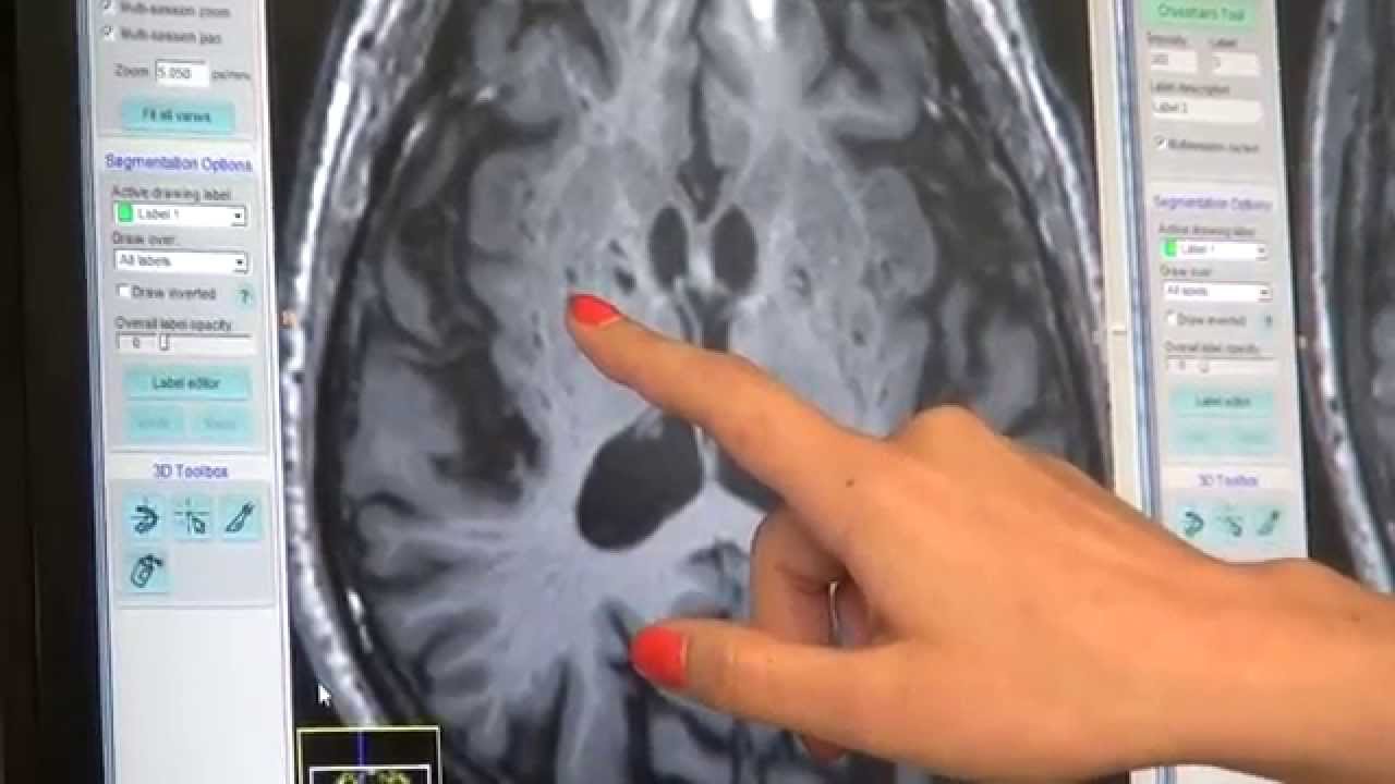 Poor Sleep May Affect Brain s Ability To Clear Waste YouTube Poor Sleep May Affect Brain s Ability To Clear Waste YouTube