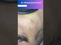 Micro scar revision surgery for chicken pox scar | Scar revision surgery in Ranchi| #shorts #scar