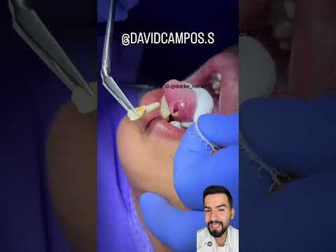 DIENTE EN LA LENGUA