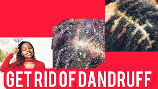 HOW TO TREAT AN ITCHY DANDRUFF SCALP BEFORE WASH DAY||DREADLOCS & BRAIDS