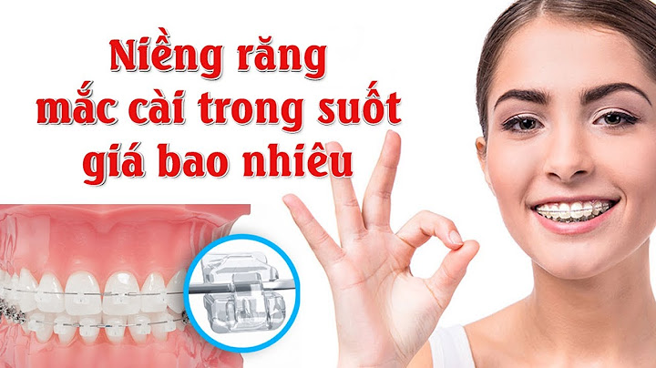 Niềng răng mắc cài trong bao nhiêu tiền năm 2024