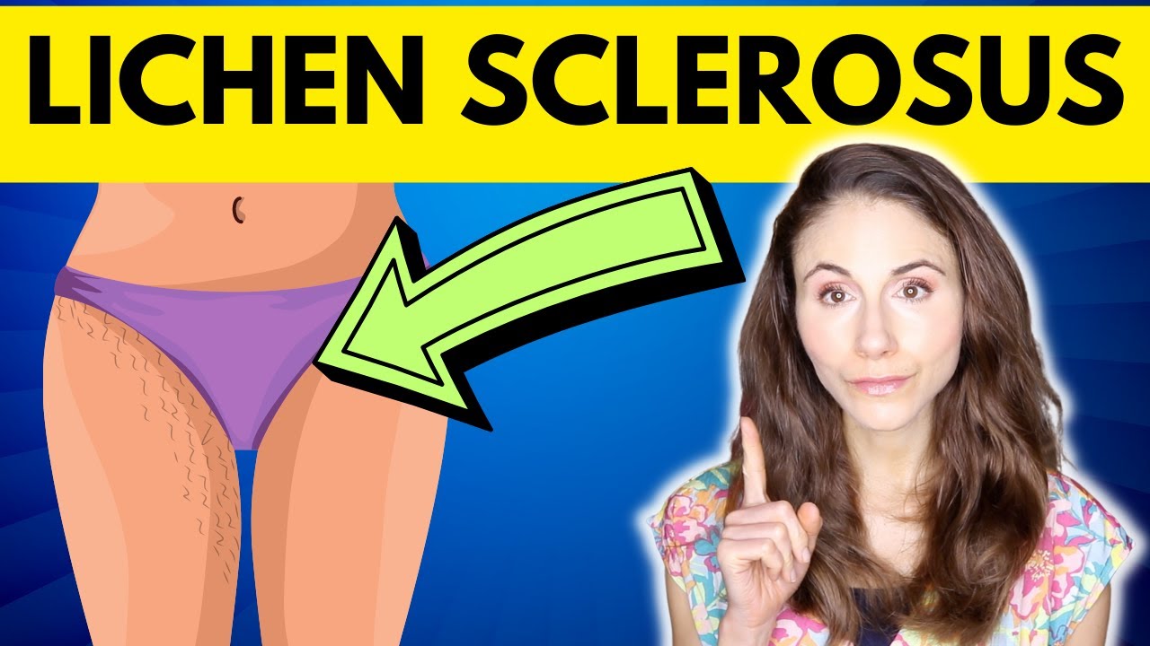 Lichen Sclerosus WHY YOU HAVE IT HOW TO TREAT IT YouTube Lichen Sclerosus WHY YOU HAVE IT HOW TO TREAT IT YouTube
