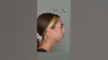 Chin Implant BEFORE & AFTER #plasticsurgery #beforeandafter #chinimplant