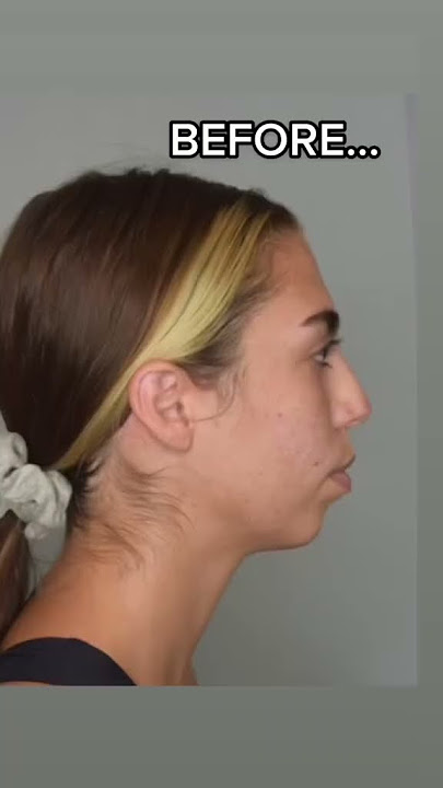 Chin Implant BEFORE & AFTER #plasticsurgery #beforeandafter #chinimplant