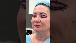 Blefaroplastie superioară realizată la Clinica Doctor Levy