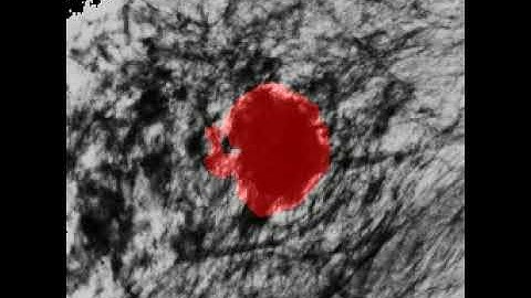 Breast Cancer Segmentation using Deep Learning