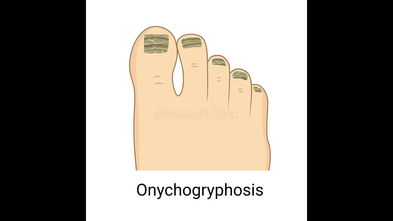 Onychogryphosis Or ram's horn nails ; Definition, Causes, Symptoms, Diagnosis, Treatment