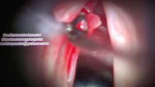 Surgery for Vocal Polyp_Vocal Abuse