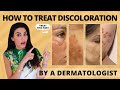 Dermatologist reviews 4 types of hyperpigmentation  treatments  tips