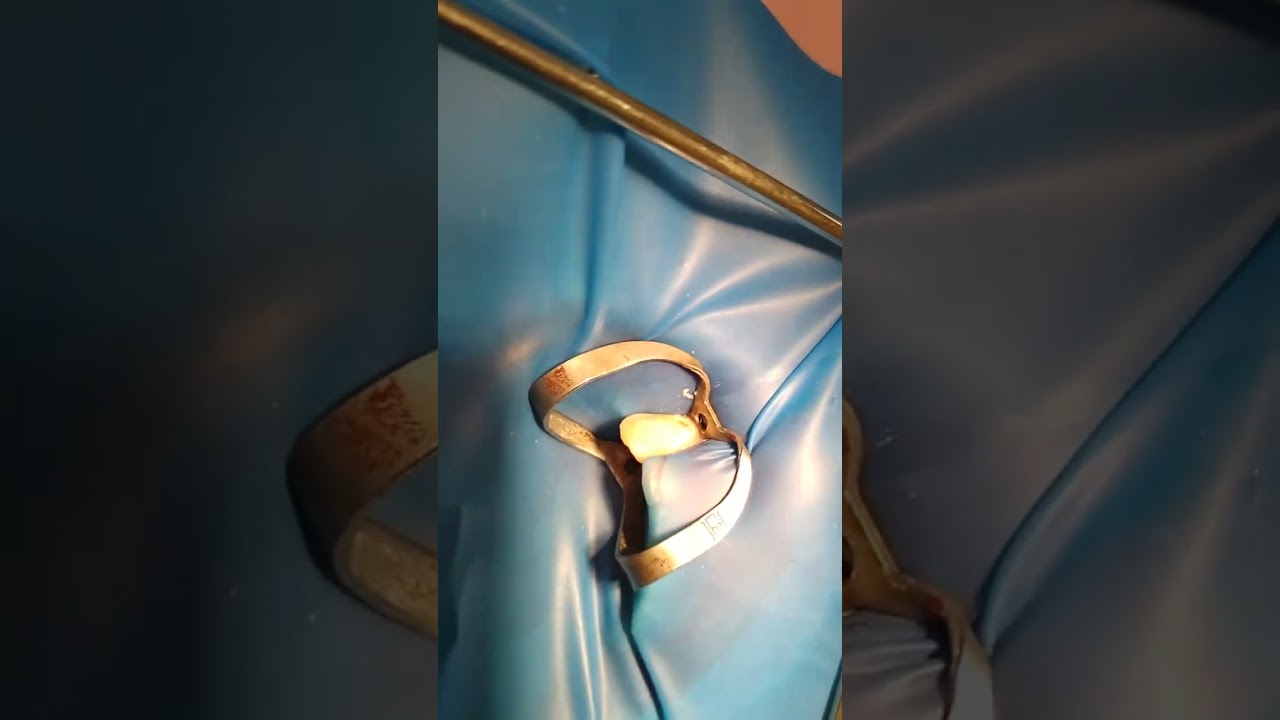 Single isolation 32 tooth.