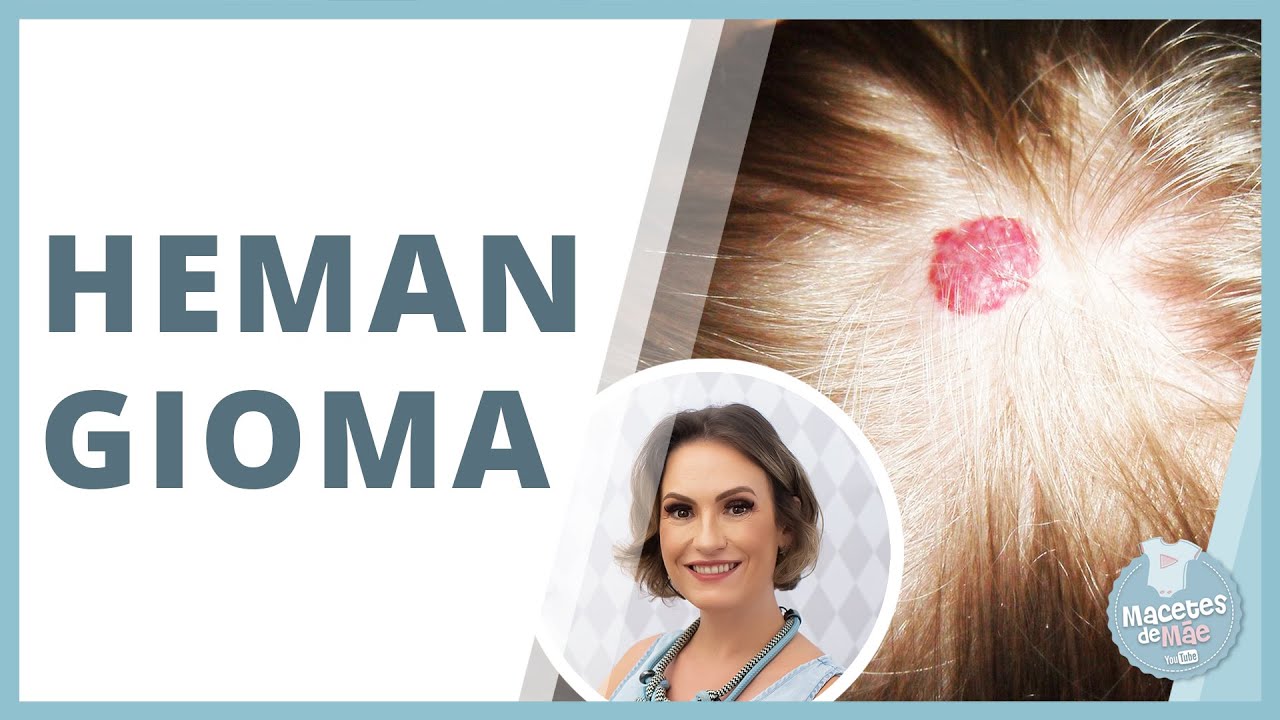 HEMANGIOMA INFANTIL - MANCHAS NA PELE DO BEBÊ | MACETES DE MÃE