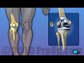 Knee replacement preop patient education