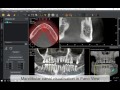 How to draw the mandibular canal and to visualise in 3D view Quickvision 3D