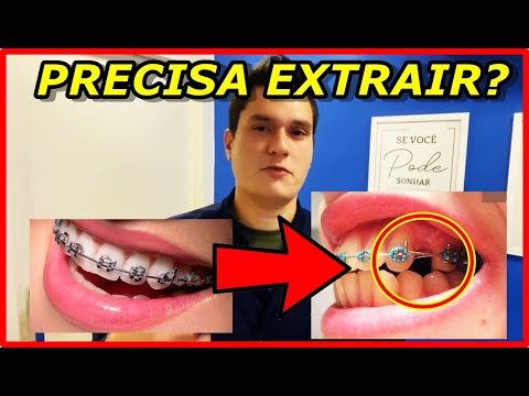 Vídeo: Por Que Arrancar Dentes Não é Como Extraí-los