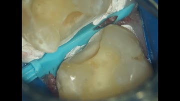 free hand deep marginal elevation DME with resin composite under dental operating microscope