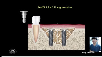 Easy 3-D ridge augmentation using #SANTA