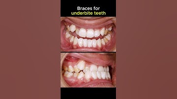 Braces transformstion, underbite teeth #braces #orthodontist #dentist