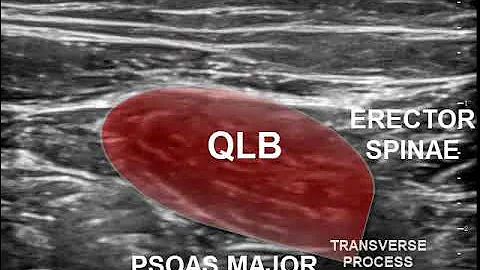 ULTRASOUND QLB BLOCK TYPE 3 TRANS MUSCULAR