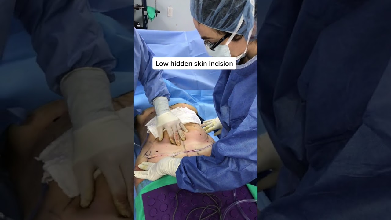 Tummy Tuck in 30 seconds #shorts