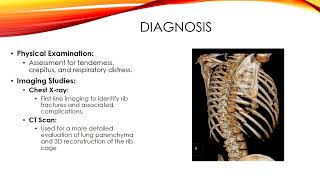 Fixing the fractured rib: current guidelines East Master Class 3 Rib Fracture Fixation Indications Techniques Post Op Management