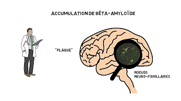 Comment se déclenche la maladie d'Alzheimer