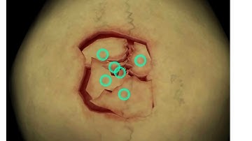 skull(cranial ) fracture surgery asmr