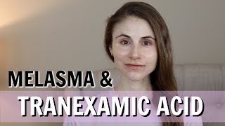 TRANEXAMIC ACID FOR MELASMA (PILLS, CREAMS, INJECTIONS)| DR DRAY