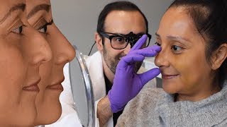 Rhinoplasty Reveal: Gracie's Surgery and Recovery Experience