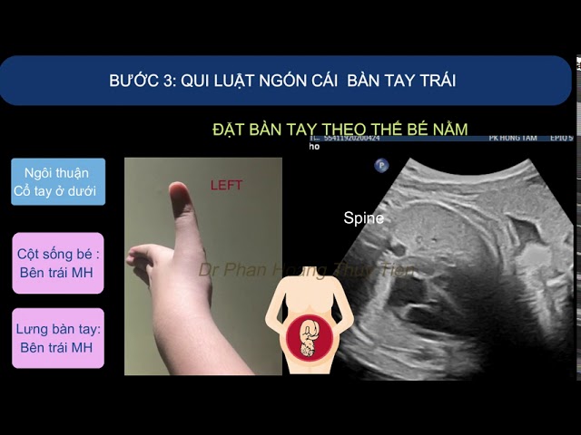 Siêu âm tim thai: Tư thế tim bên phải. Bs Phan Hoàng Thuỷ Tiên auf YouTube ansehen Siêu âm tim thai: Tư thế tim bên phải. Bs Phan Hoàng Thuỷ Tiên auf YouTube ansehen