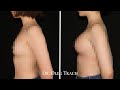 Результат увеличения груди | Увеличение груди через подмышку | Пластика груди | Маммопластика Киев