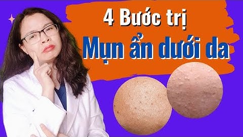 4 Bước điều trị Mụn Ẩn dưới da tại nhà hiệu quả - Bác sĩ Nguyên