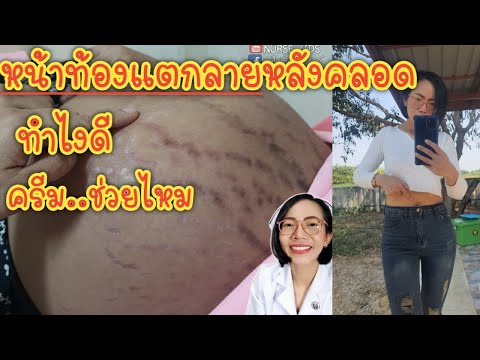 หน้าท้องแตกลายหลังคลอดทำไงดี ครีมนี้ช่วยไหม|Nurse Kids