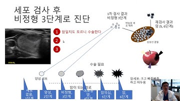 갑상선 결절 유튜브 상담